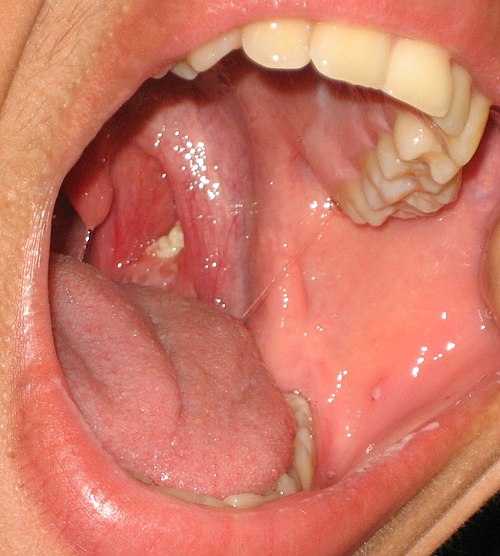 Tonsil stones