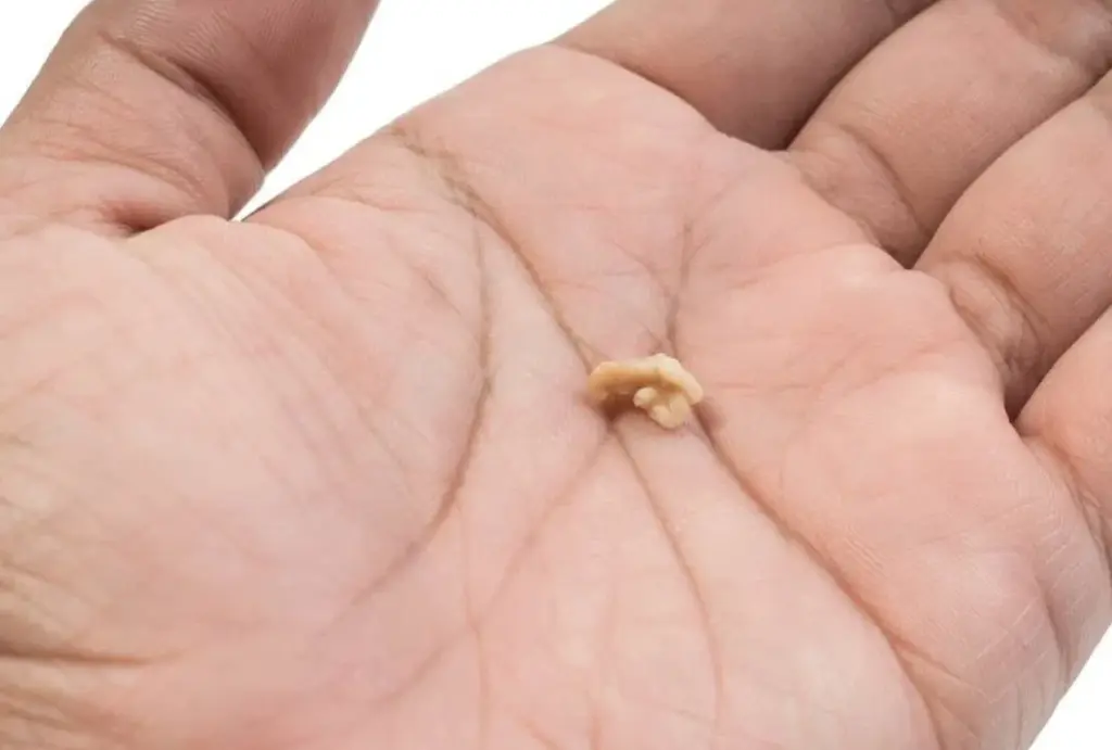 biggest tonsil stone