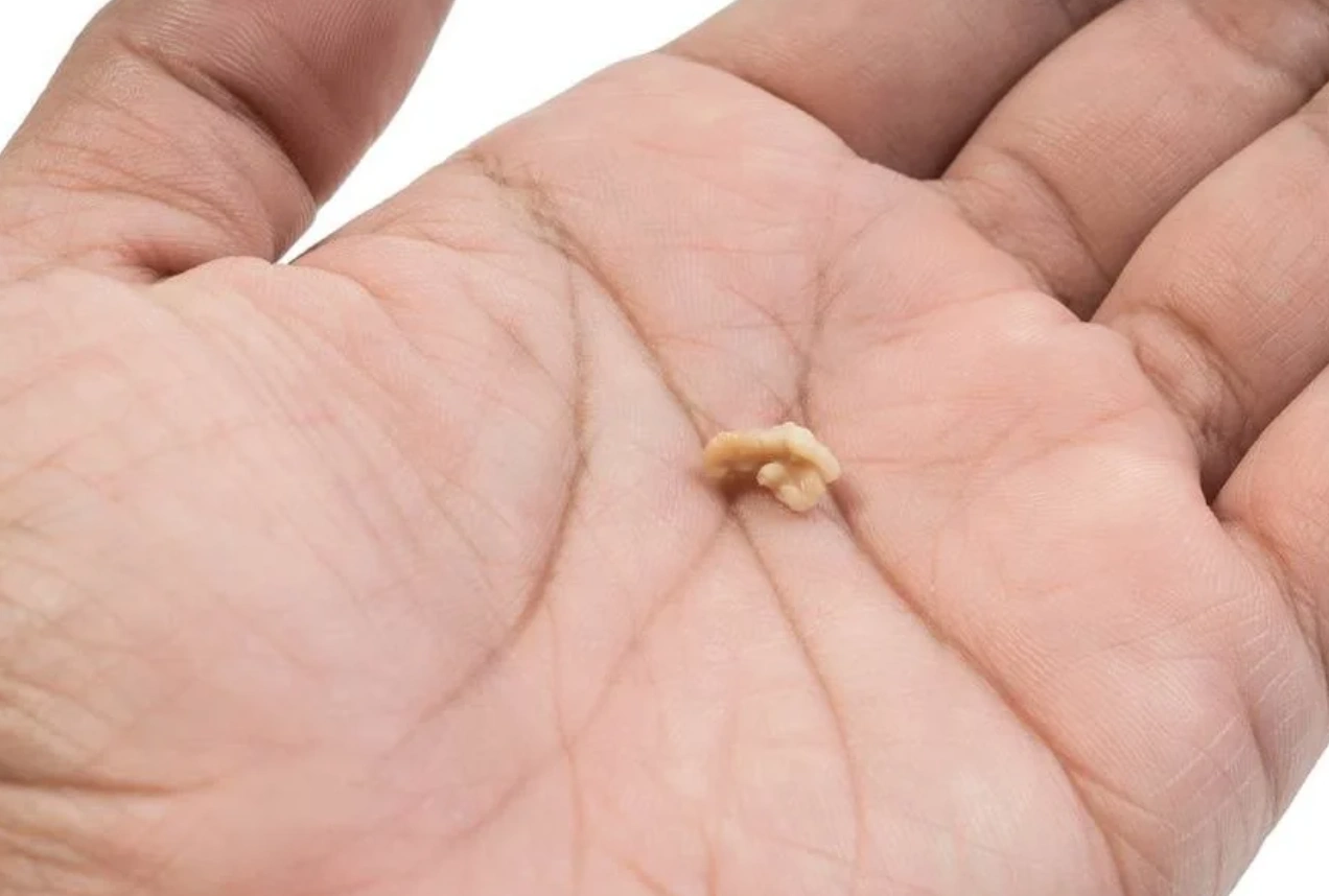 biggest tonsil stone