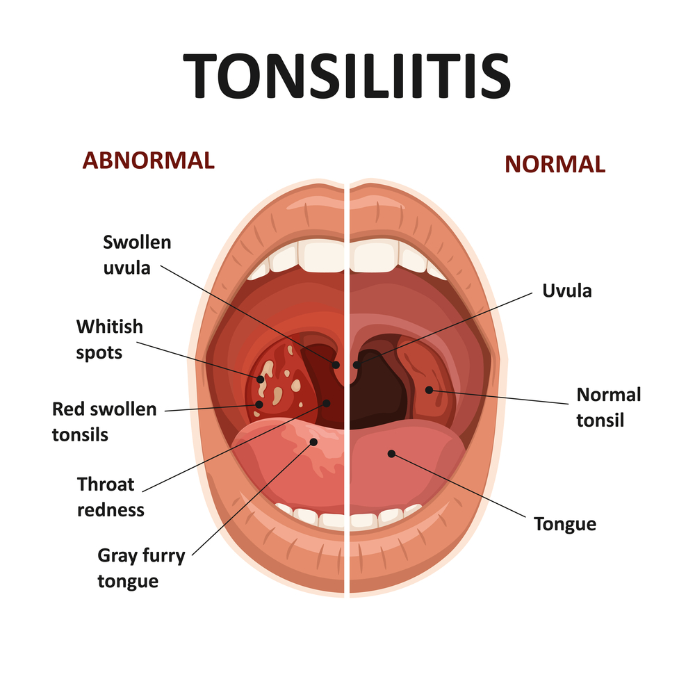 Tonsil stones