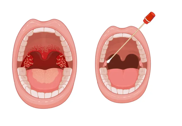 Understanding Tonsil Stones in Children understanding tonsil stones in children