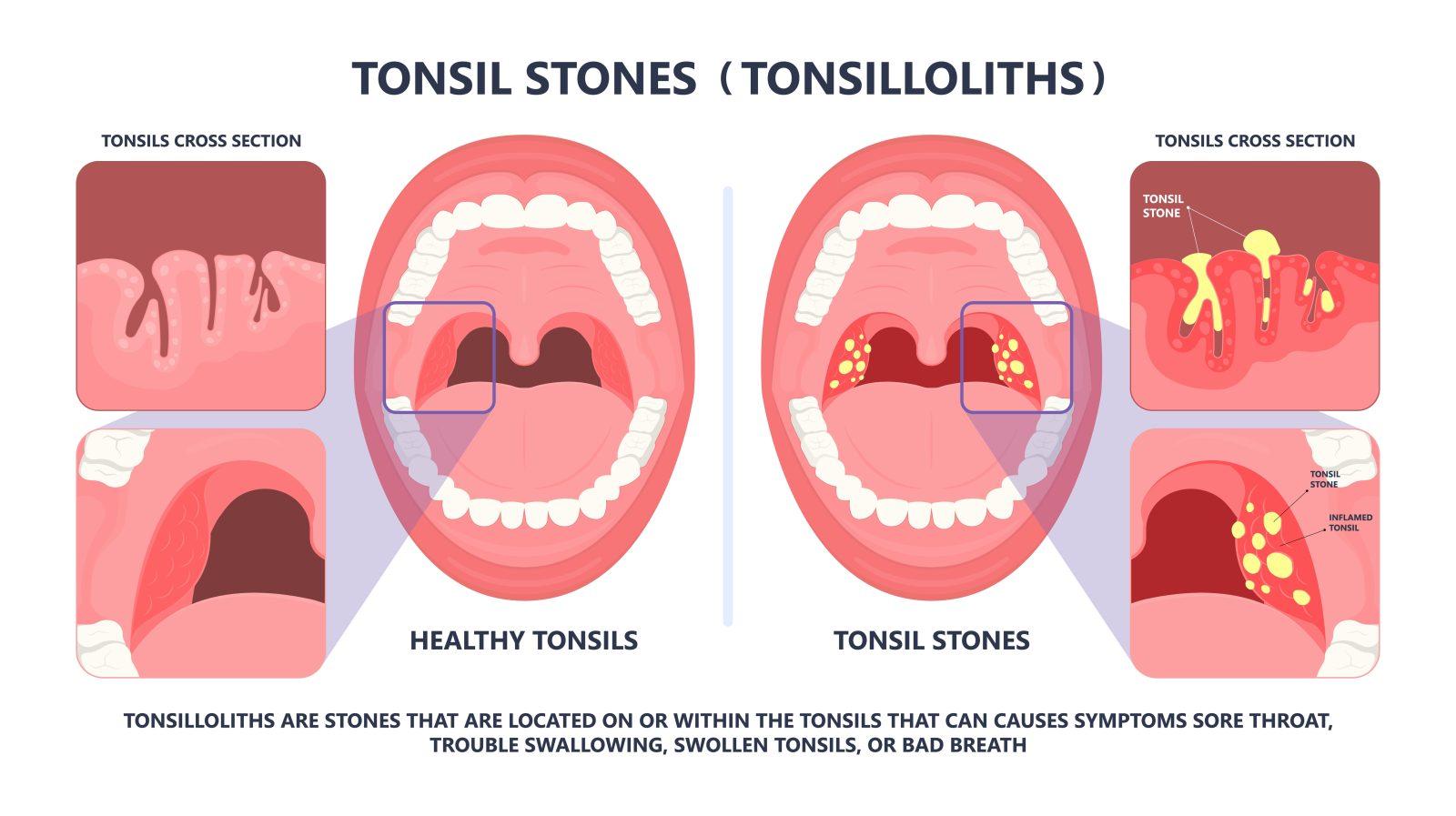 Tonsil stones