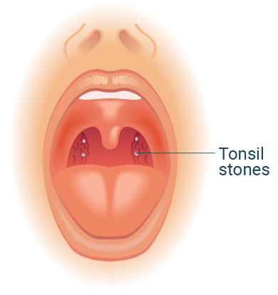 tonsil stones ce4623